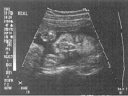 Ultrasound showing face of 20-week preborn baby
